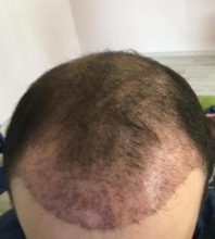 hair implants turkey (20)