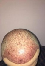 hair-implant-turkey