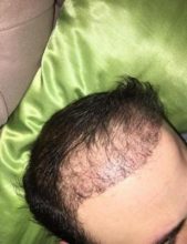 hair implants turkey (4)