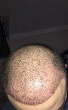 hair implants turkey (5)