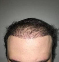 hair implants turkey (6)