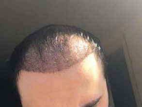 hair implants turkey (7)