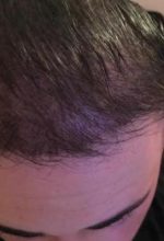 hair implants turkey (8)