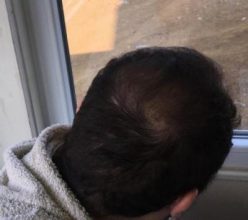 hair implants turkey (9)