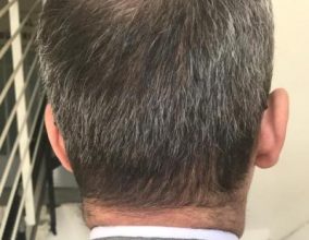 hair loss treatment for men (1)