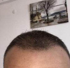 hair loss treatment for men (2)