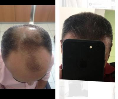 hair loss treatment for men (4)