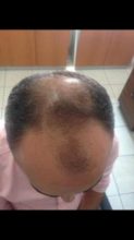 hair plantation (1)