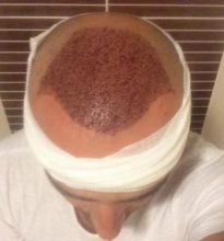 hair plantation (2)