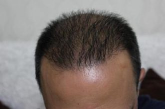 hair plugs (1)