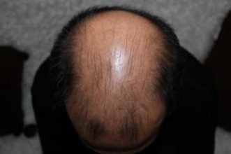 hair-plugs