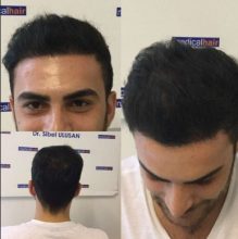 hair plugs (2)