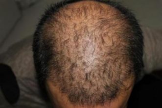 hair plugs (5)