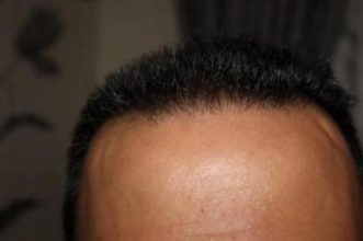hair plugs (6)