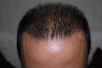 hair regrowth (1)