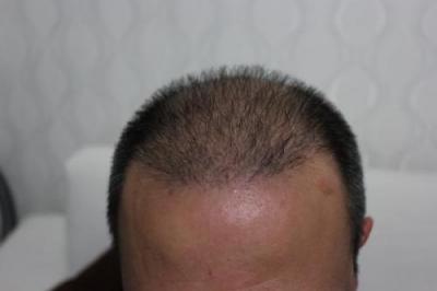 hair regrowth (2)