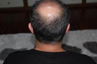 hair regrowth (3)