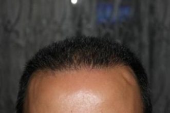 hair regrowth (4)