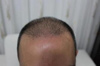 hair replacement (1)
