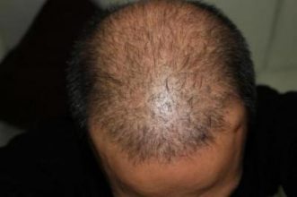 hair replacement (2)