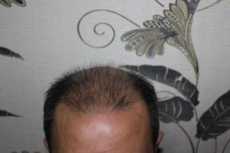hair replacement (3)