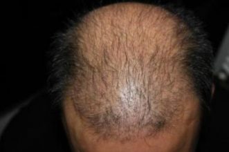 hair replacement (4)