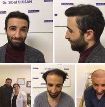 hair restoration (1)