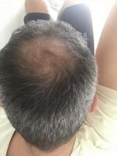 hair restoration cost (2)