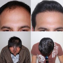 hair transplant Turkey cost