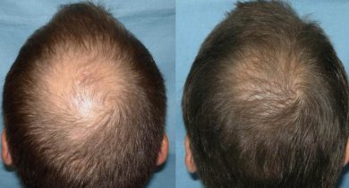 hair-transplant-antalya