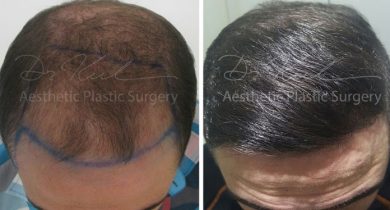 hair transplant before and after