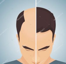 hair transplant before and after (2)