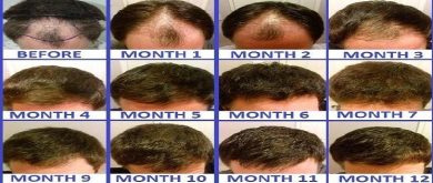 hair transplant before and after