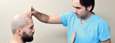 hair transplant by a doctor