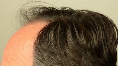 hair transplant center turkey (10)