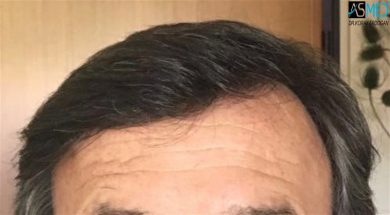 hair transplant center turkey (12)