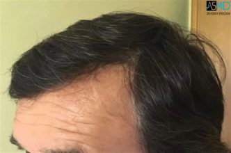 hair transplant center turkey (13)