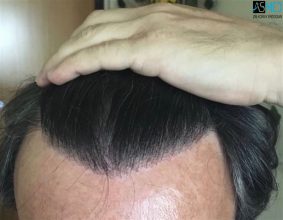 hair transplant center turkey (2)