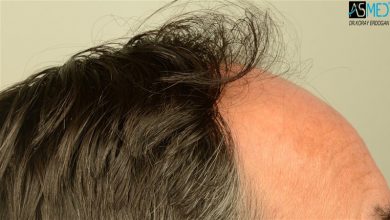 hair transplant center turkey (3)