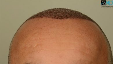 hair transplant center turkey (4)