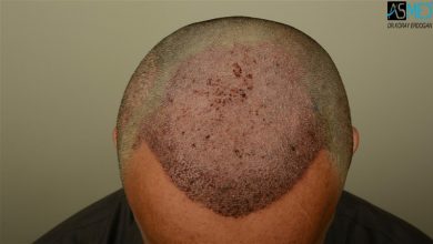 hair transplant center turkey (5)