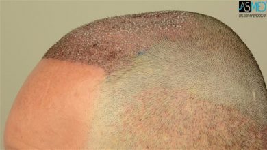 hair transplant center turkey (6)
