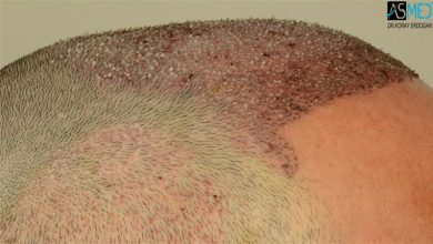 hair transplant center turkey (7)