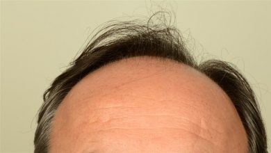 hair transplant center turkey (8)