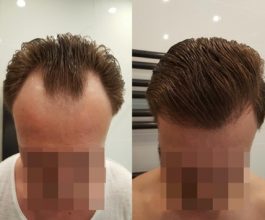 hair transplant clinic in turkey