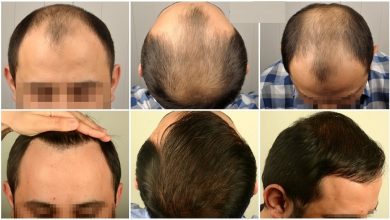 hair transplant cost