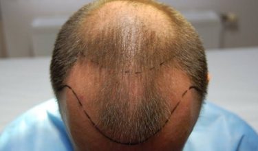 hair transplant fue
