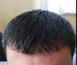hair transplant in Turkey (1)