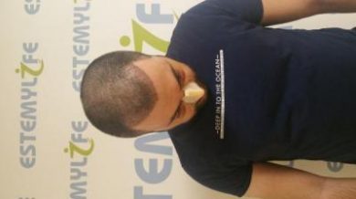 hair-transplant-in-Turkey