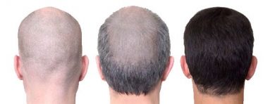 hair transplant in Turkey